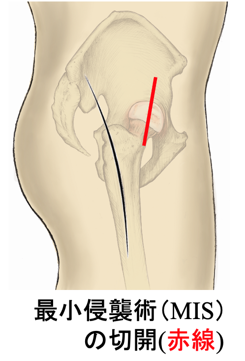 ALSアプローチによる人工股関節手術の切開例