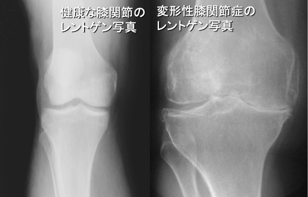 健康な膝関節と変形性膝関節症のレントゲン比較