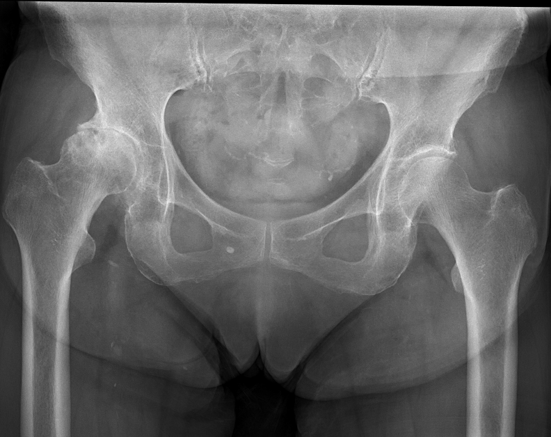 変形性股関節症のレントゲン画像