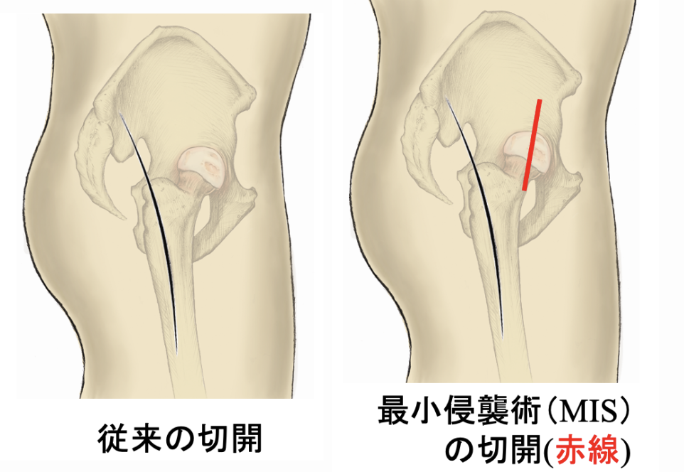 人工股関節置換術（THA）のアプローチ方法｜後方系・前方系の特徴とALS